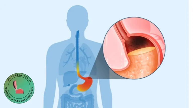 عملية ارتجاع المريء بالمنظار