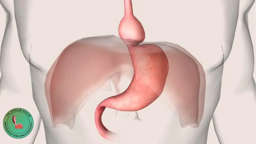 مضاعفات فتق الحجاب الحاجز