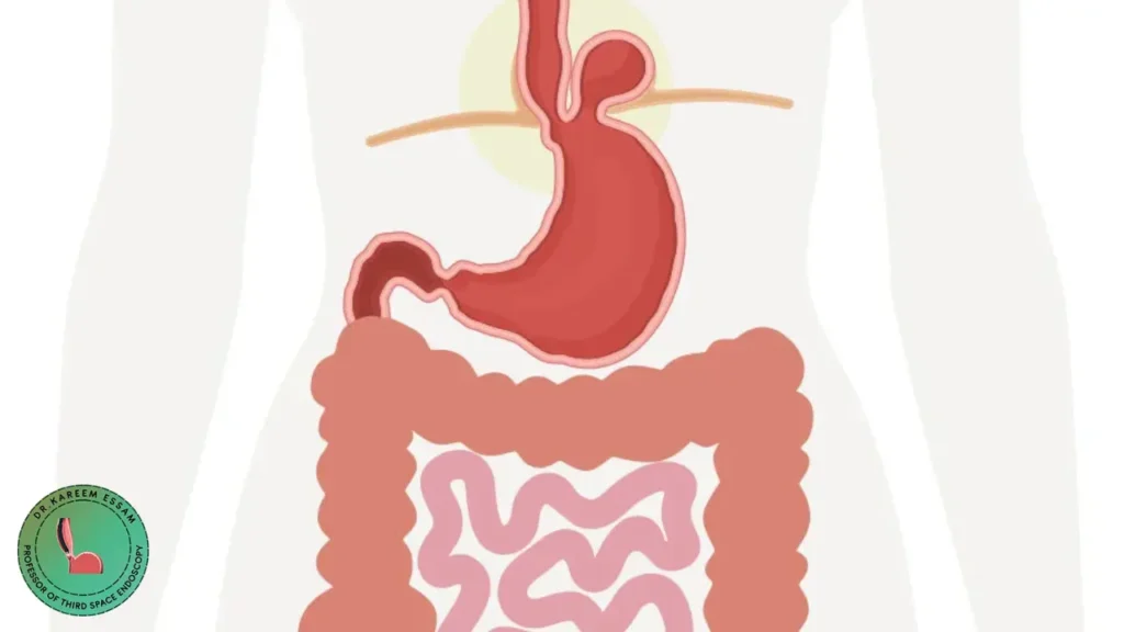 أفضل دكتور لعملية فتق الحجاب الحاجز بدون جراحة