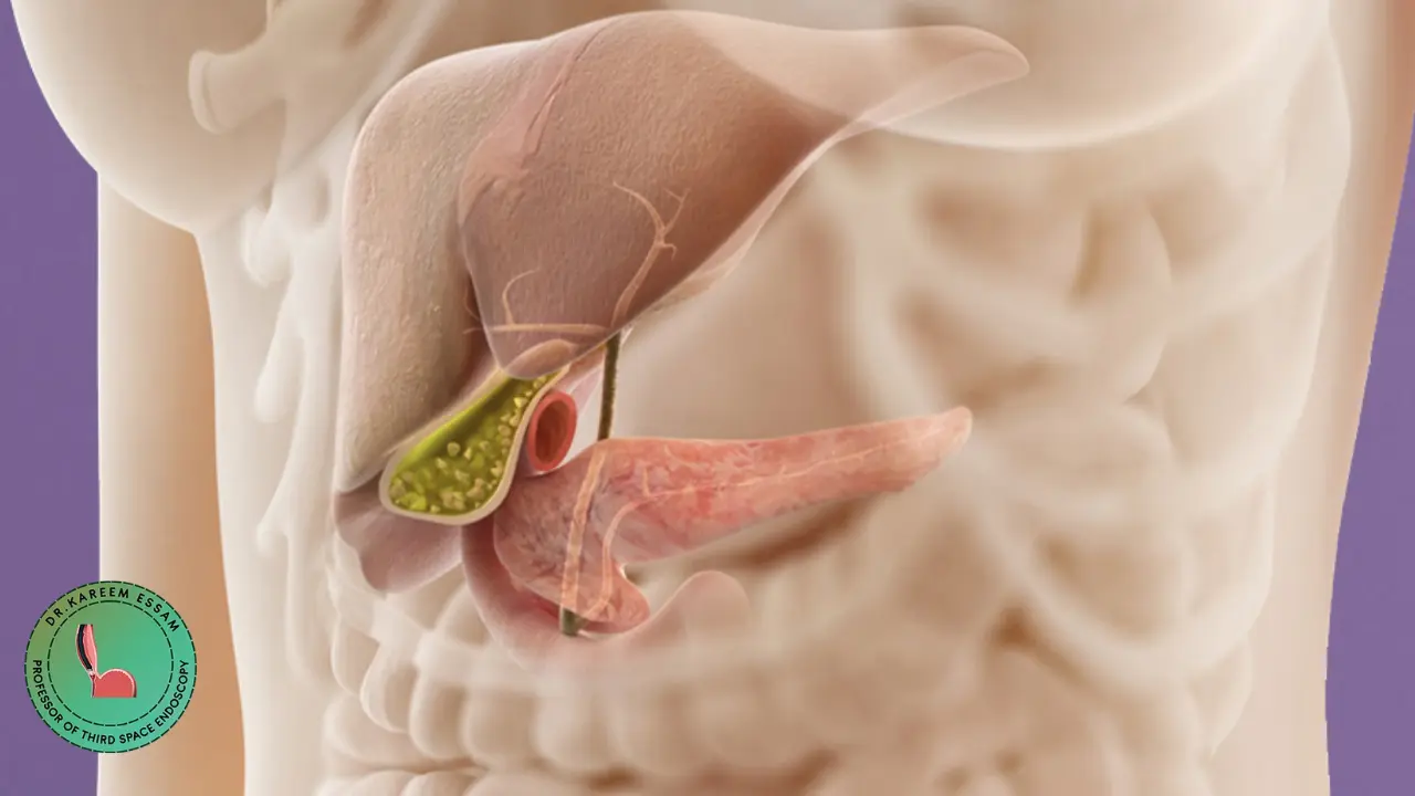 أعراض انسداد القناة المرارية