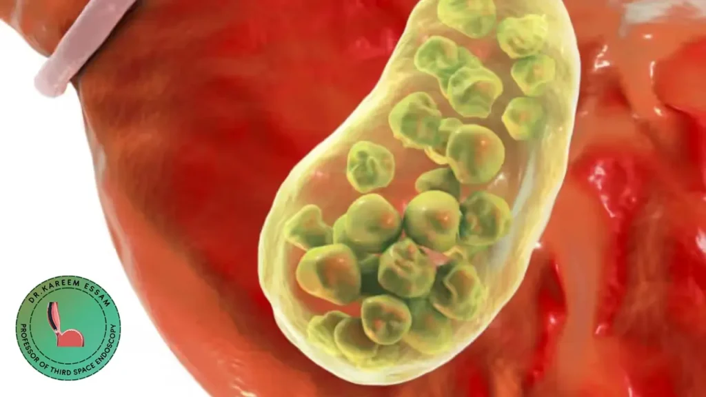 خطورة انسداد القناة المرارية