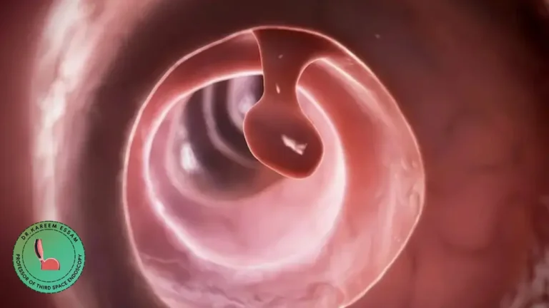 علاج زوائد القولون