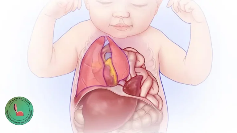 فتق الحجاب الحاجز الخلقي