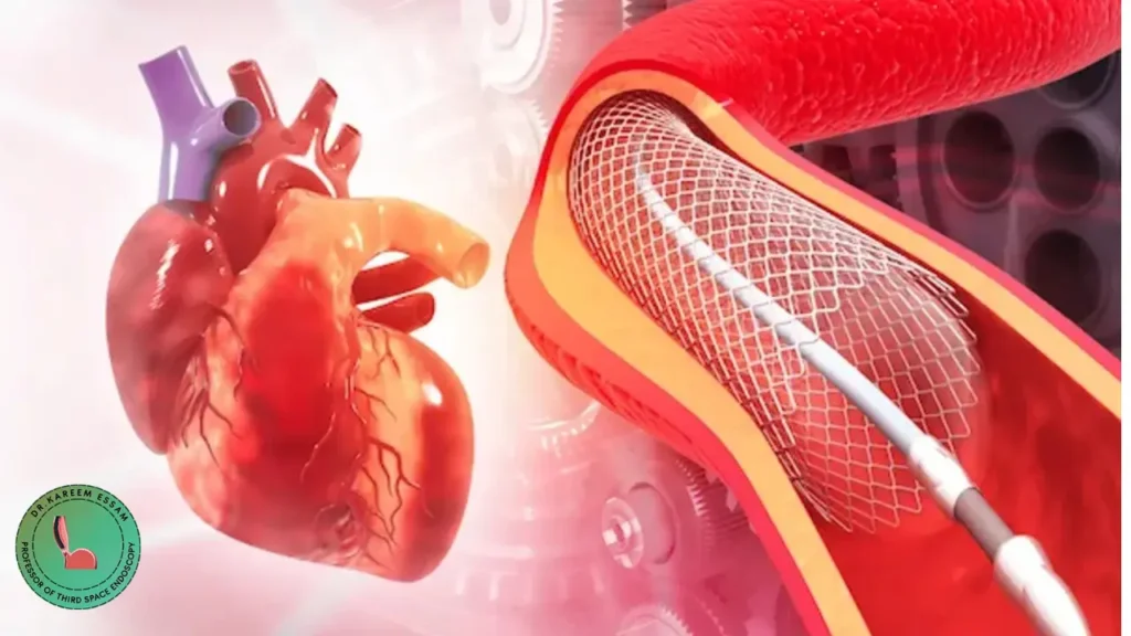 مدة بقاء دعامة القناة المرارية