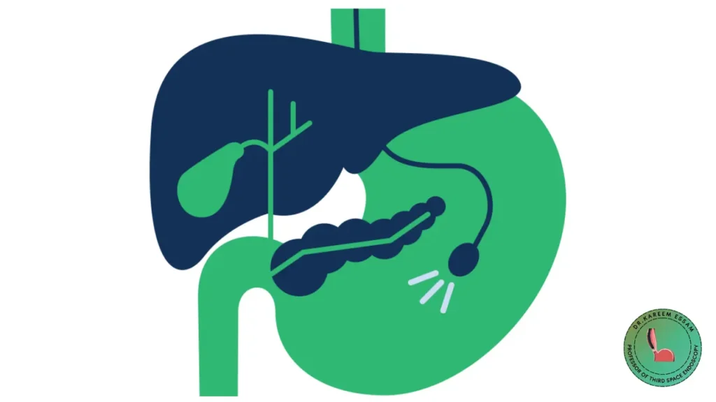 منظار القنوات المرارية والبنكرياس