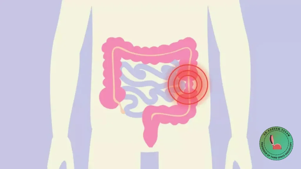 تجربتي مع كسل الأمعاء