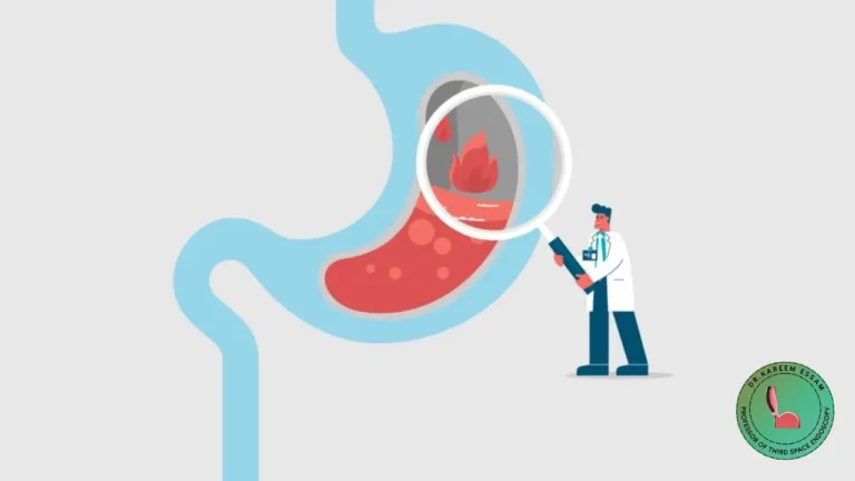 هل ارتجاع المريء يسبب الوفاة