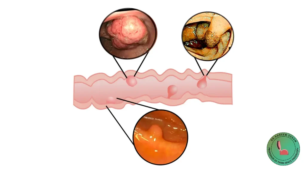 اعراض ورم القولون الحميد