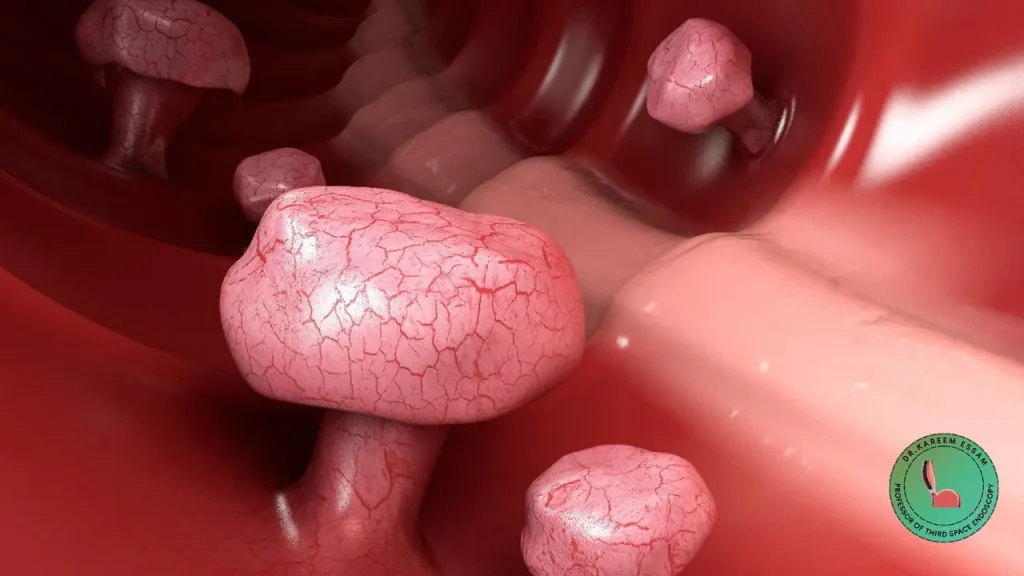 حجم لحمية القولون